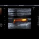 Thrombosis of femoral vein, subacute: US - Ultrasound
